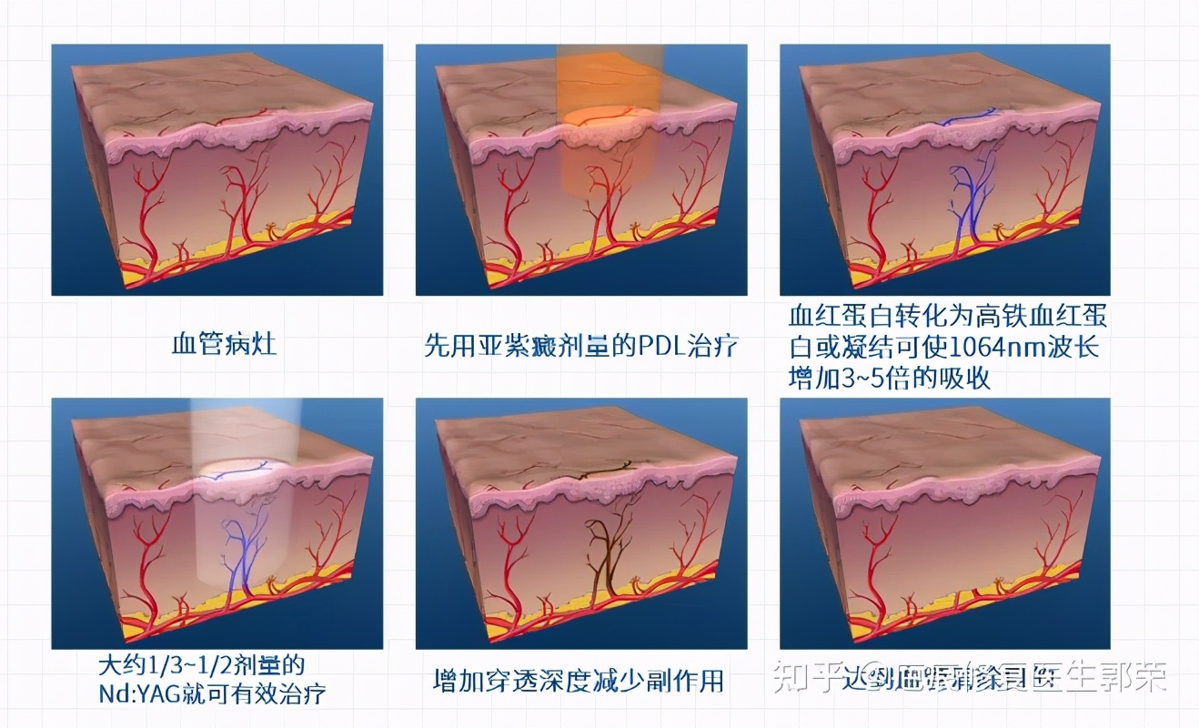 cynergy激光治疗仪副作用,cynergy双波长血管激光