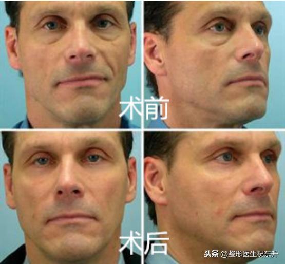 面部悬吊提升术的后遗症有哪些,面部悬吊提升术对比图