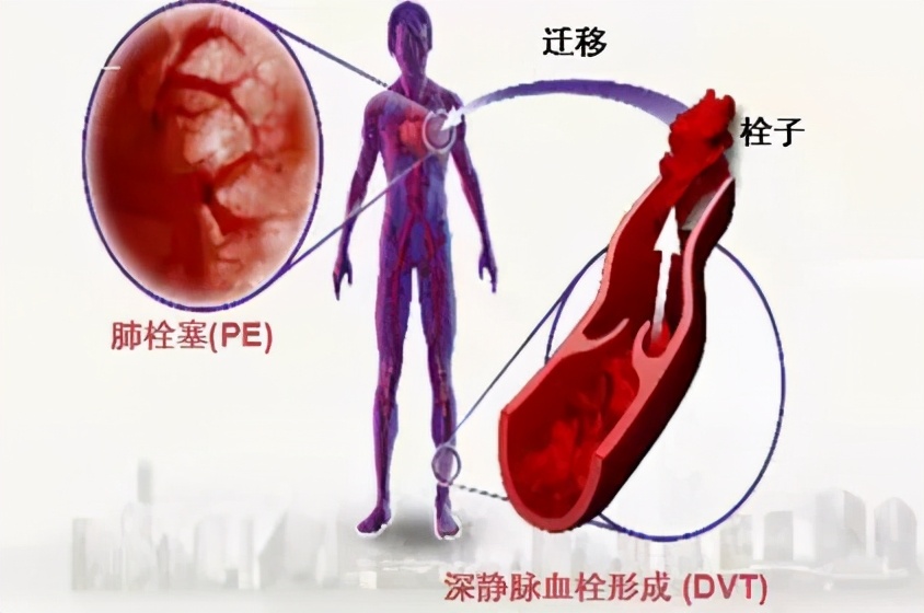 静脉血管堵怎么治疗,小隐静脉血栓处理