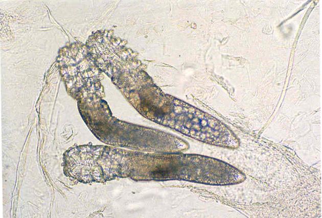 100人里就有20人中招，清洁不到位导致脸上冒虫，毛孔需要早清洁
