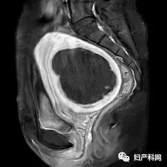 微波消融治疗子宫肌瘤,微无创治疗技术