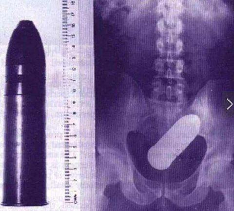 不作死就不会死,看看这些被人类搞进身体里的异物