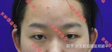 可以只开眼角不割双眼皮吗,双眼皮到底要不要开眼角