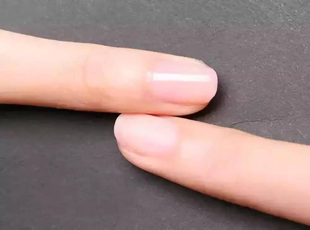 大拇指指甲有竖纹跟凹陷怎么回事,大拇指甲上有白色竖纹是怎么回事