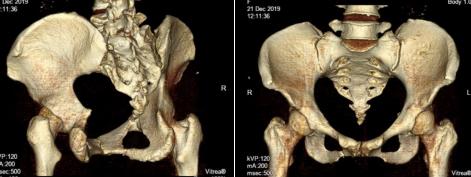 伤筋动骨一百天要躺着吗,伤筋动骨一百天就万事大吉了吗