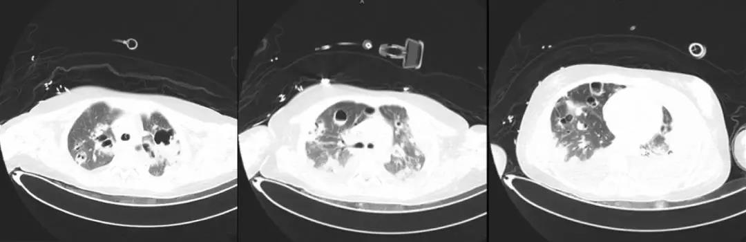 万古霉素治疗mrsa疗程,万古霉素用于mrsa的作用机制