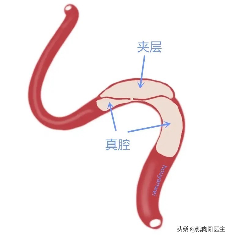 颈动脉闭塞血管夹层,颈动脉夹层是什么原因形成的