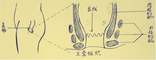 肛周脓肿挂线引流形成肛瘘几率,肛瘘拖了一个月可以吗