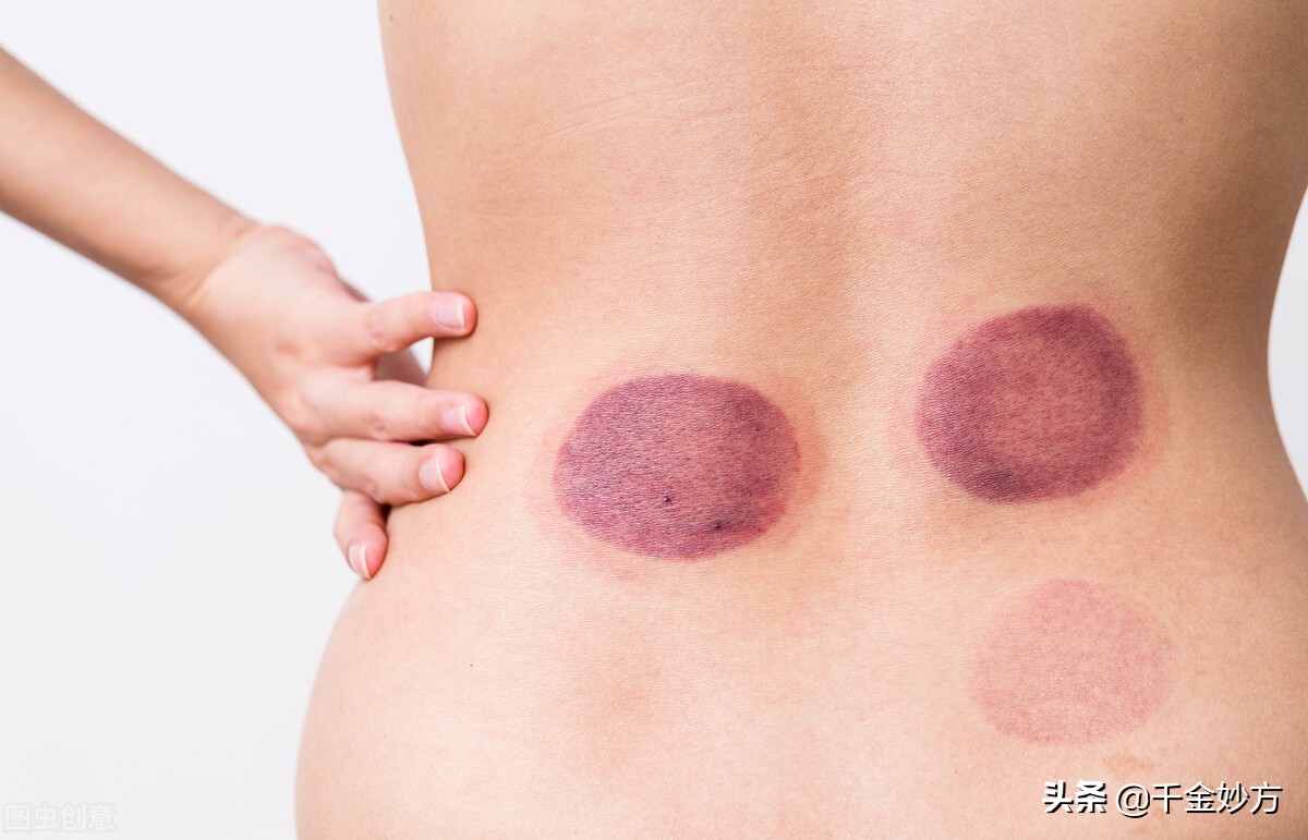 拔罐，身上的血泡和黑印是毒素吗？医生告诉你答案