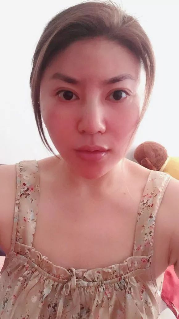 41岁考虑线雕和拉皮哪个好,线雕40岁后的感受