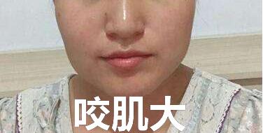 咬肌切除瘦脸术的注意事项,咬肌怎么切除