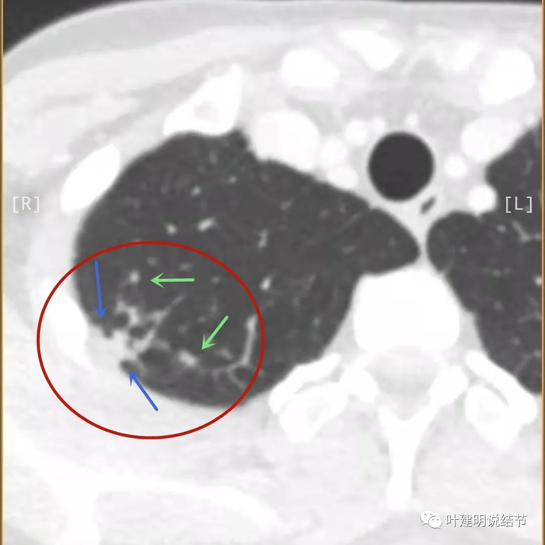 临床诊断孤立性肺结节,空洞型结节一般是什么性质
