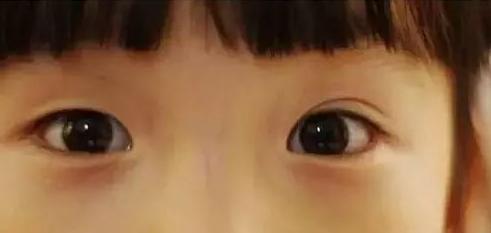 割双眼皮是种什么体验,割双眼皮什么样子才是增生