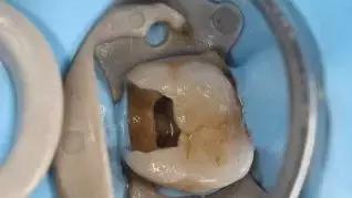 补牙4年后钻心的痛怎么回事,补牙一两年后出现疼痛什么原因