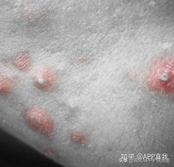 维a酸药膏治疗痘痘效果,中成药维a酸类口服药有哪些