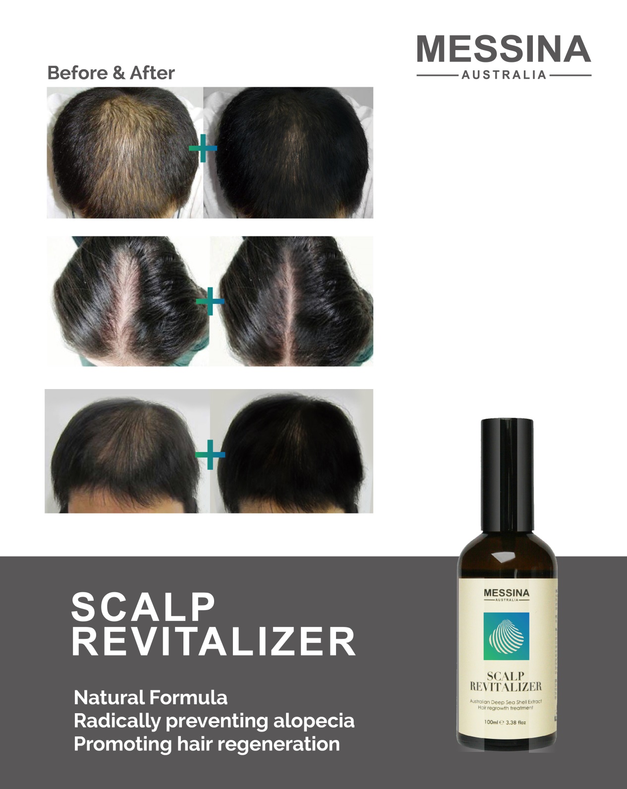 脱发脱成灭霸,我加入了妇愁者联盟!澳洲messina带你找回自信