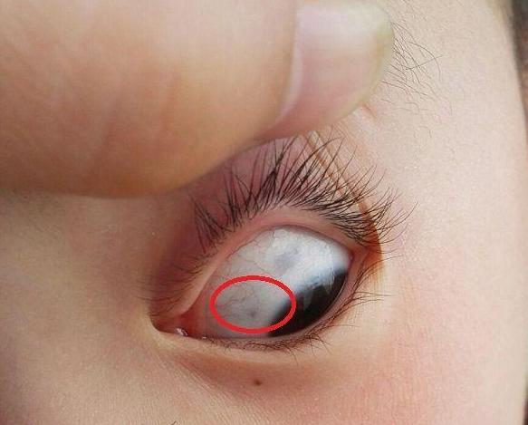 小孩眼白有黑点是啥原因,儿童眼白有黑点是怎么回事