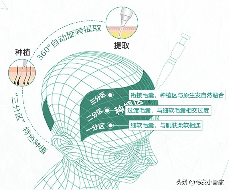 植发是智商税吗,蛋白矫正植发是不是智商税