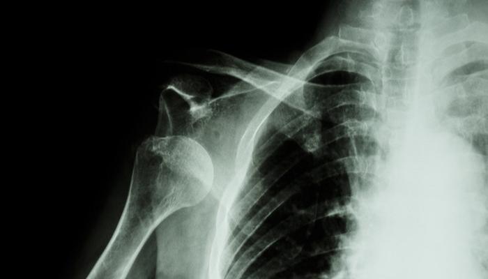 肩关节脱位复位用什么药,肩关节脱位复位后怎么治疗