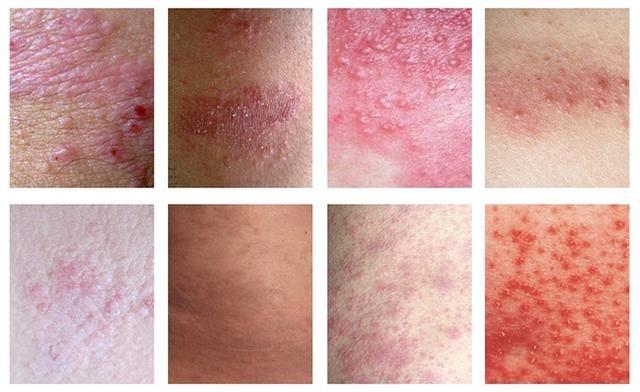 宝宝湿疹反复发作，妈妈拿它没辙？远离湿疹“折磨”做好这6点！