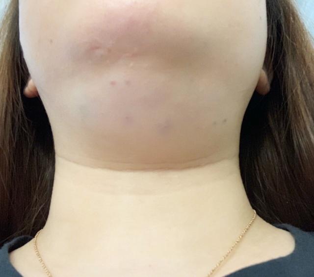 如何消除双下巴让脸型更好看,下巴松弛造成的双下巴面相