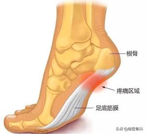 足底筋膜炎跑步脚后跟疼怎么办,走路脚跟痛当心足底筋膜炎