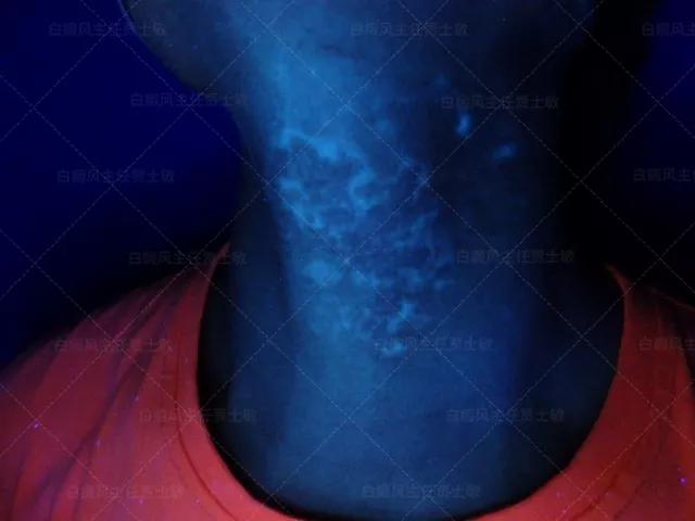 18岁男孩高考备战,18岁男孩白斑