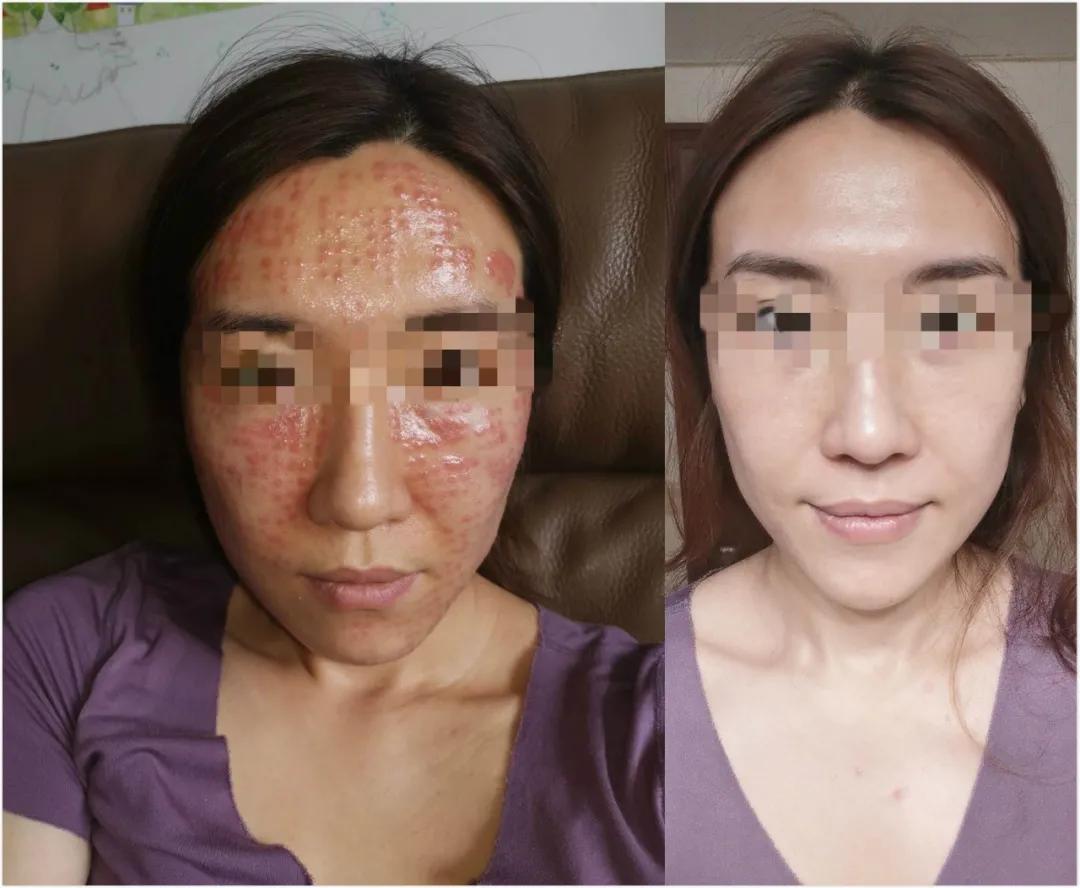 一次水光针相当于敷了1000次面膜,一次水光针等于10次补水