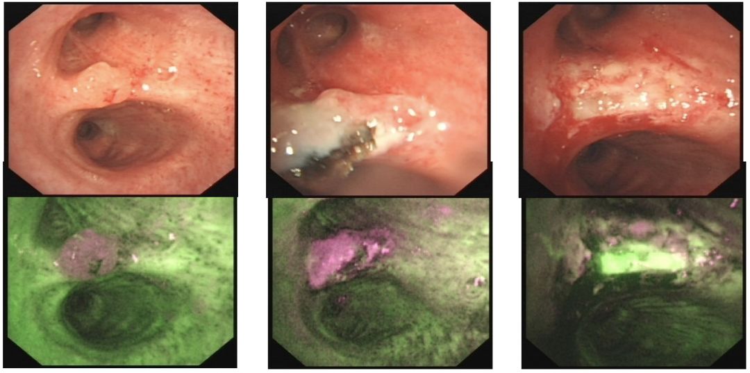 「经支气管镜粘膜活检」诊断的特殊优势？对哪些患者风险较大？