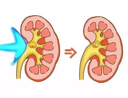 得了尿道结石怎么办,得了泌尿系统结石怎么办