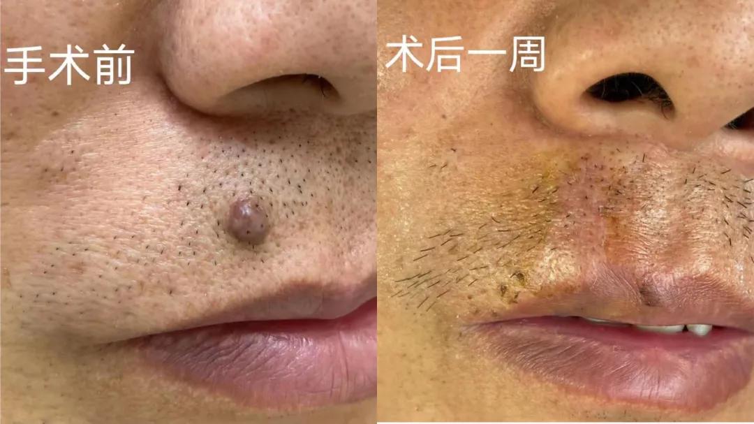 微创祛痣手术全过程,郝医生激光治疗仪疗效