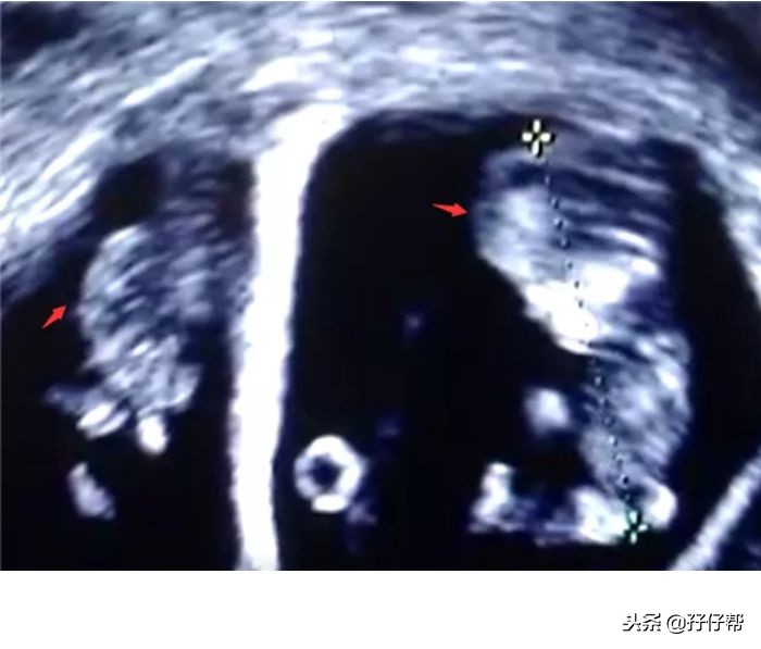 怀上双胞胎到底是幸运还是不幸,有一种生不如死的痛