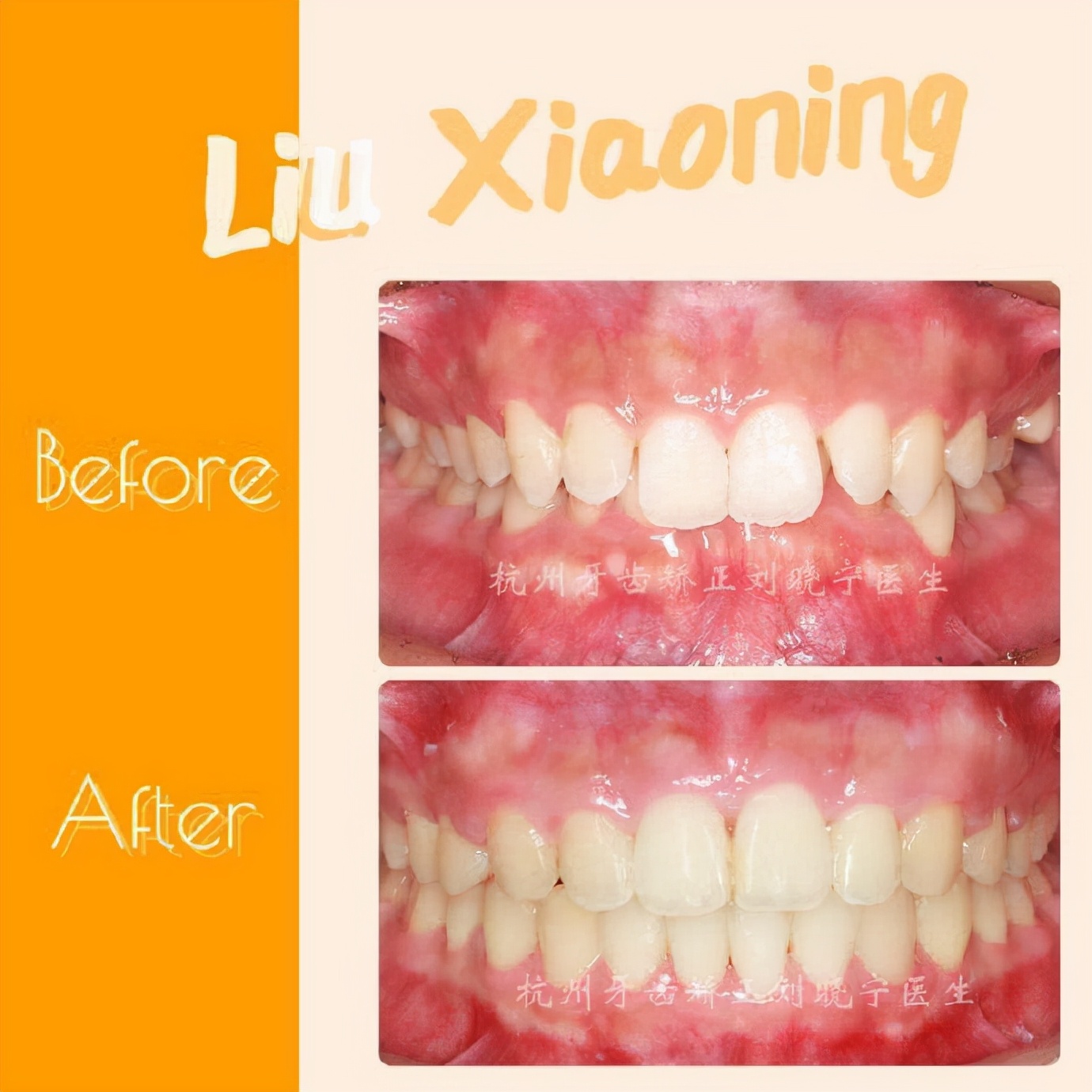 矫正牙齿如何改善露龈笑,矫正牙齿可以改善露龈笑吗