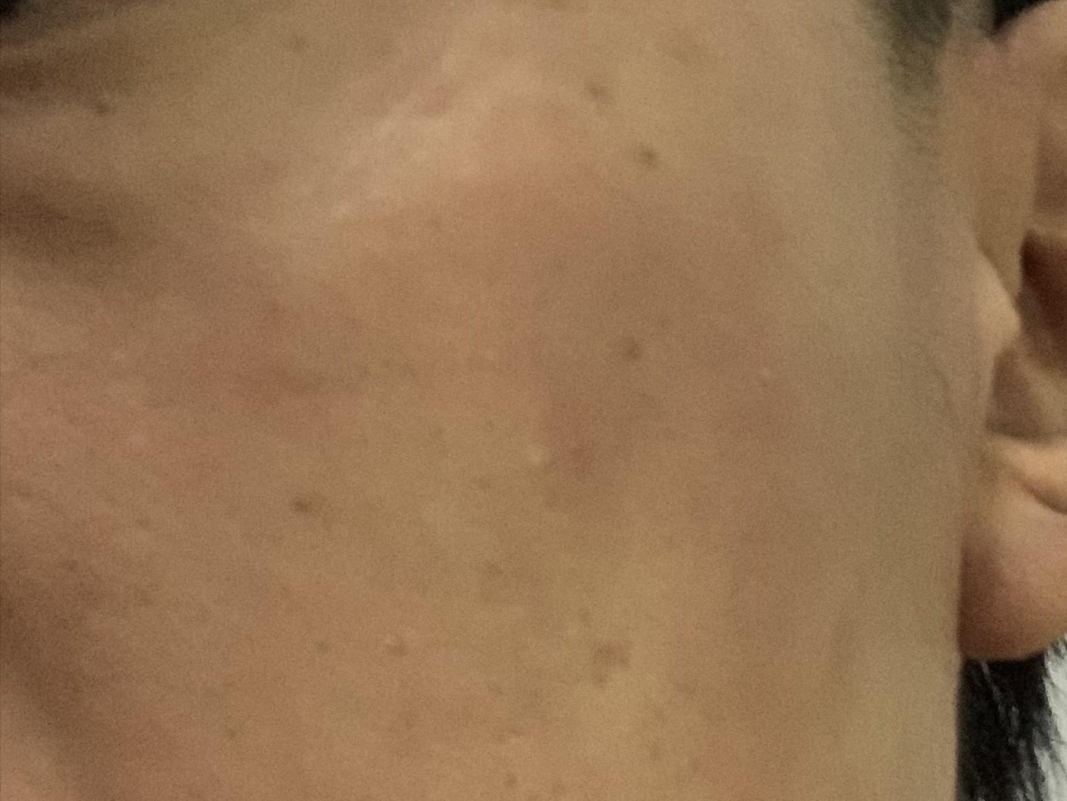 17岁女儿脸上长满痘痘，看了这篇文章才知道如何帮助她