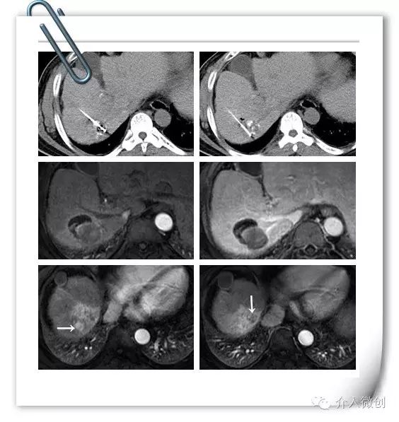 原发性肝癌伴门静脉癌栓能活多久,原发性肝癌介入治疗及进展