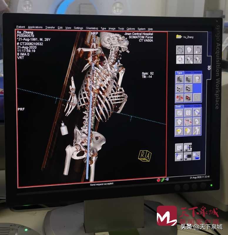 29岁小伙被1米钢筋贯穿,男子被1米钢筋穿体工友截断送医