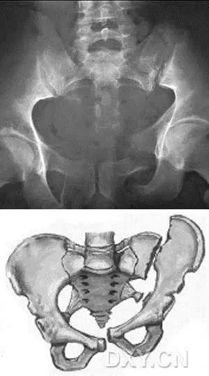几种严重骨折医学名称,常见的骨折有哪些名称