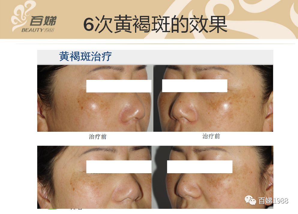 *褐斑黄**，你真正了解多少？碧芮斯带你真正了解“它”