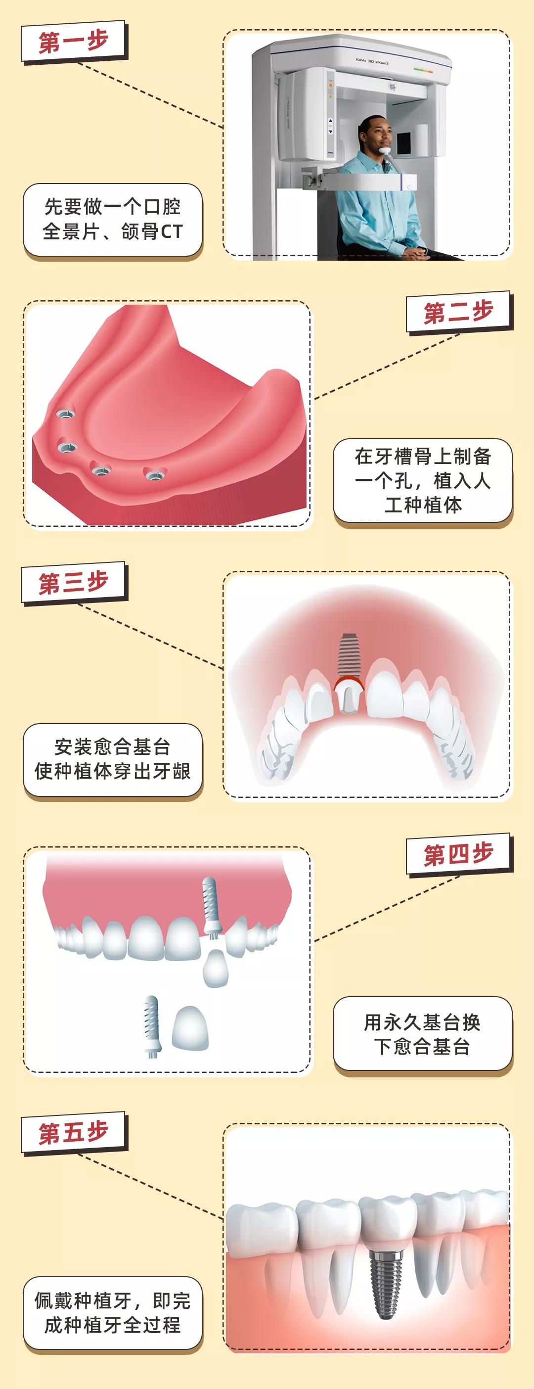 种植牙要把牙神经搞断吗,种植牙要放骨粉痛吗