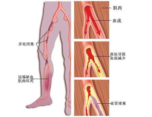 抽筋了怎么办两个动作缓解抽筋痛,频繁抽筋的原因和治疗方法