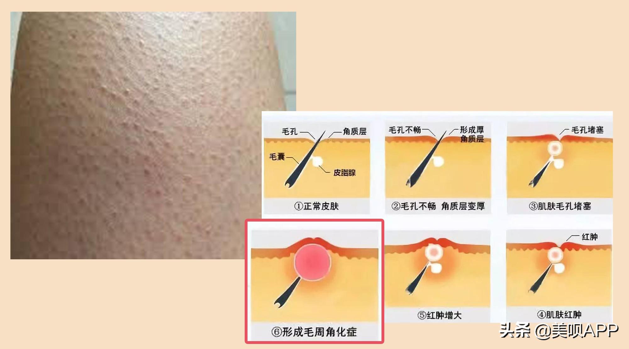 春季鸡皮肤大作战!去毛周角化也要分种类好吗?