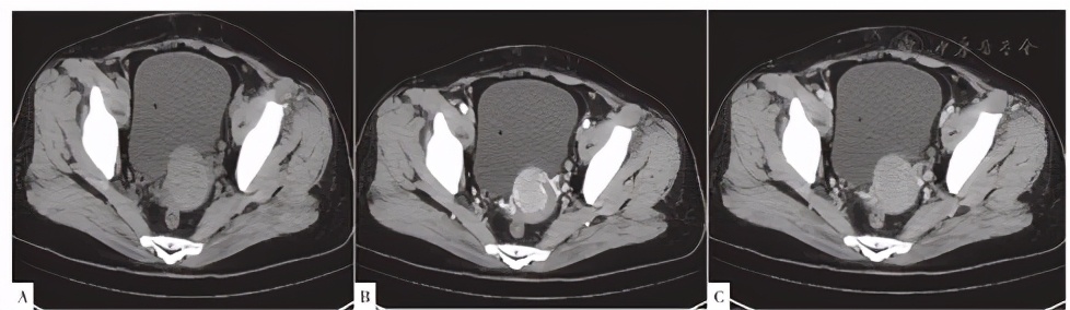 子宫良恶性肿瘤的超声诊断及鉴别,子宫肌瘤病理切片恶性肿瘤