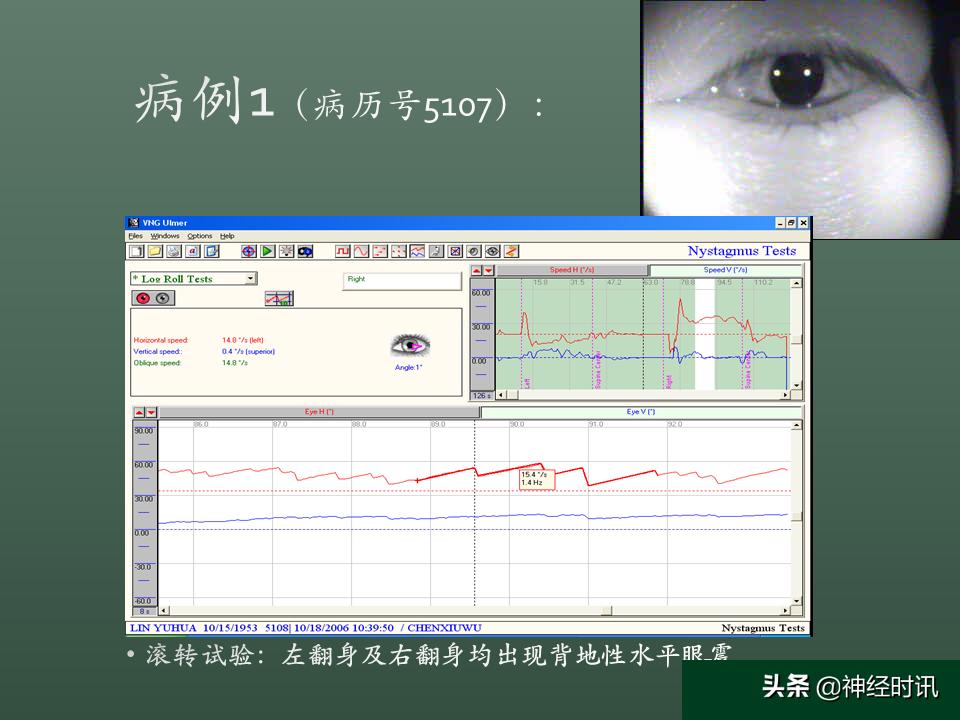 良性位置性眩晕诊断和治疗指南,良性阵发性位置性眩晕的诊断标准