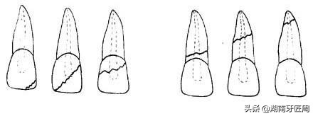 小朋友牙齿撞坏了怎么办,儿童牙齿摔掉了门牙怎么处理