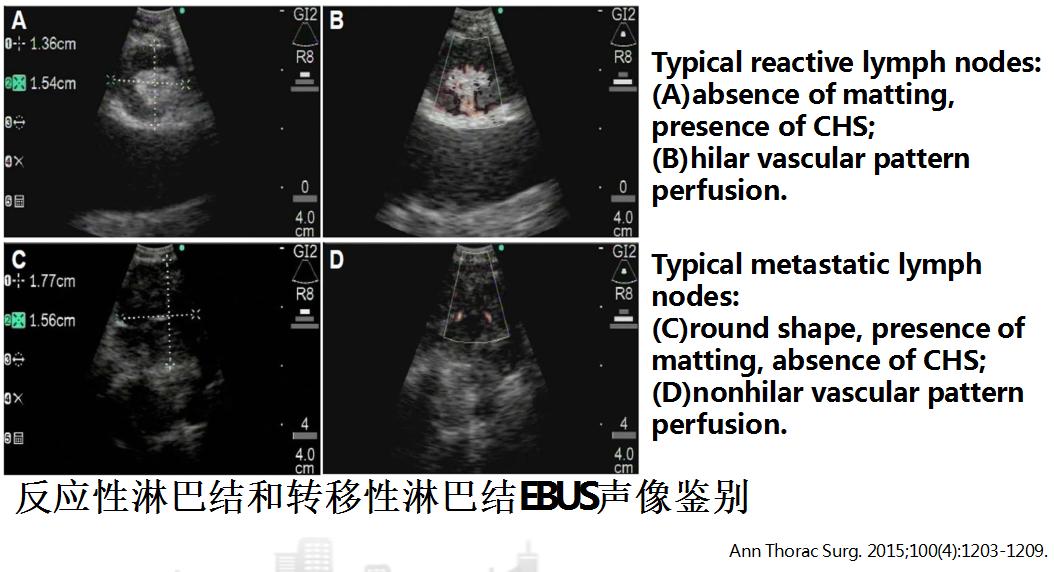 支气管镜高频电刀治疗中央型肺癌,支气管镜在早期肺癌诊断的意义