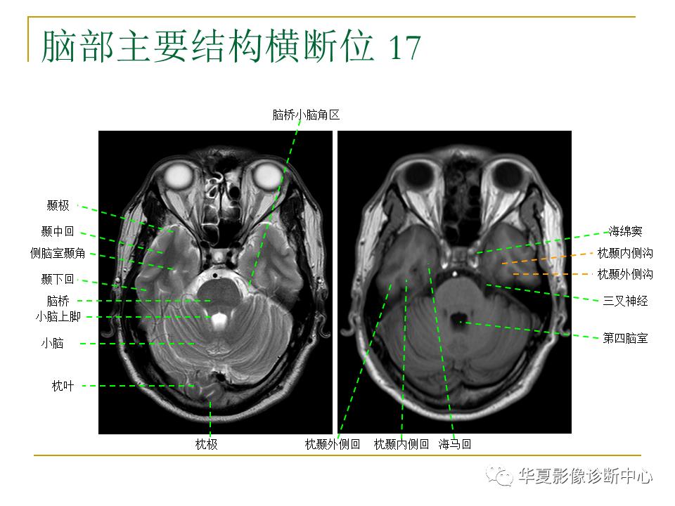 中国人脑立体定向mri应用解剖图谱,脑mri示意图