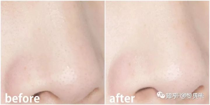 黑头去除神器排行榜,黑头粉刺清除强力推荐网红产品