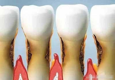 牙齿松了可以做补齿吗,牙松了用冷酸灵能固齿