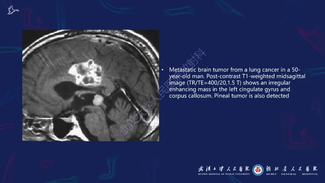 胼胝体肿瘤影像鉴别,胼胝体病变影像诊断