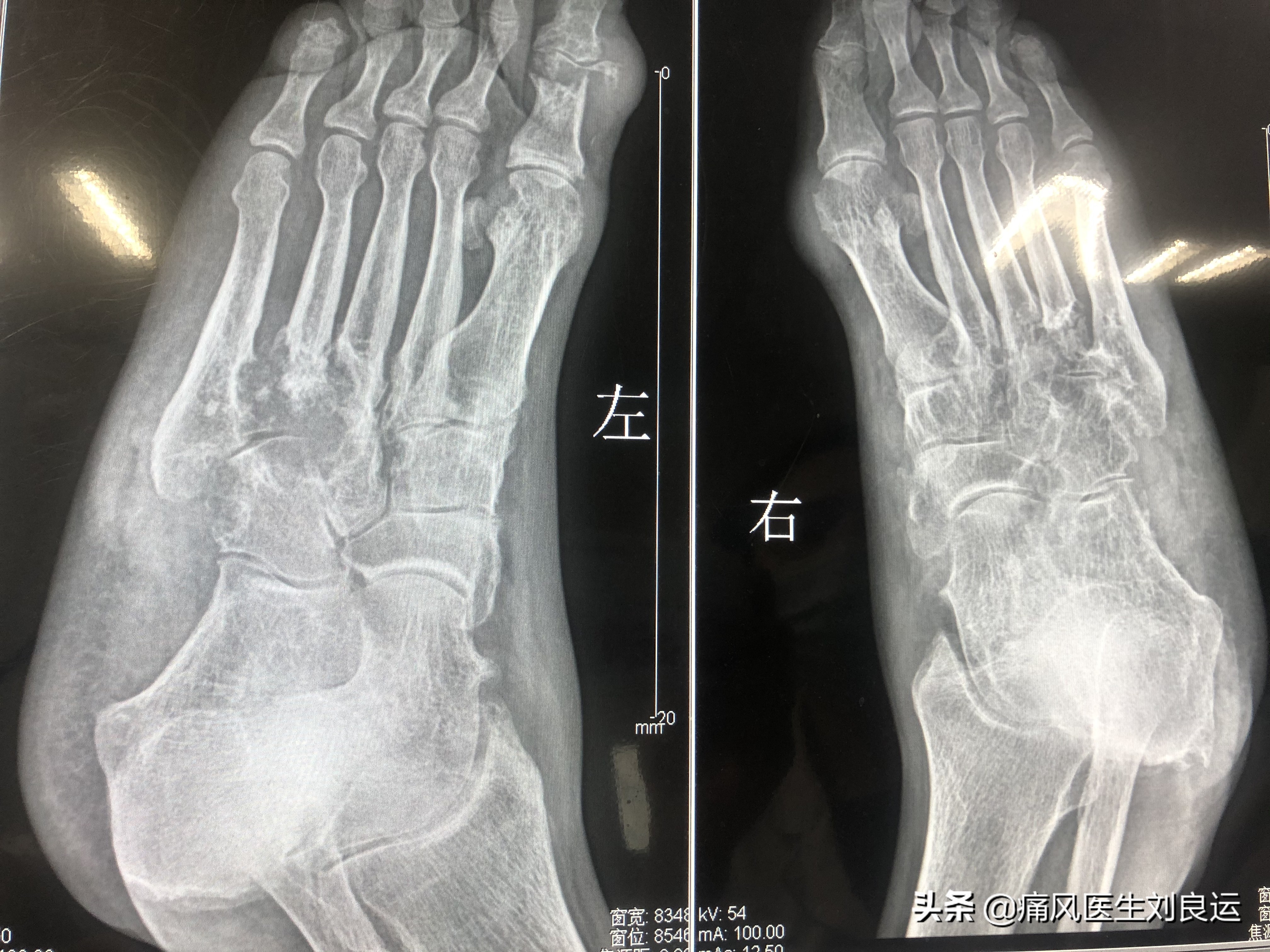 人到中年尿酸高六个生活管理要点,四十岁男人如何预防尿酸高